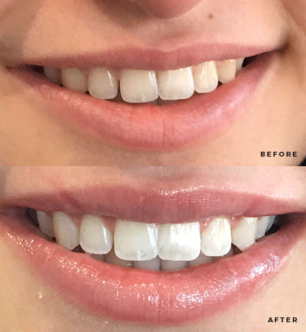 Teeth Whitening Process, Charlotte NC - Smile Labs Charlotte